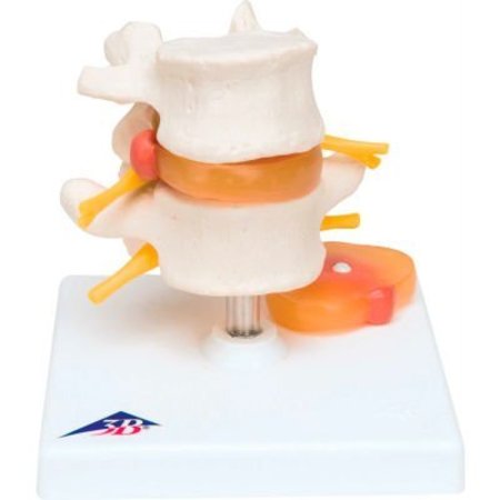 FABRICATION ENTERPRISES 3B® Anatomical Model - Lumbar Spinal Column with Prolapsed Intervertebral Disc 977726